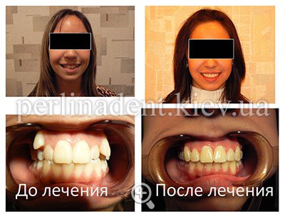 исправление прикуса зубов