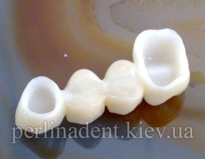 Безметалловая керамика зубы