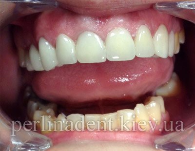 зубное протезирование на основе оксида циркония