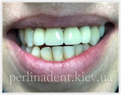 Зубні протези з безметалевої пресскераміки в Києві