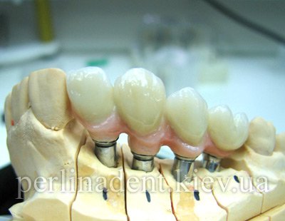 Имплантация зубов Киев
