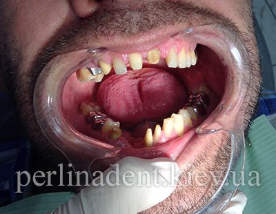 Зубные протезы из металлокерамики