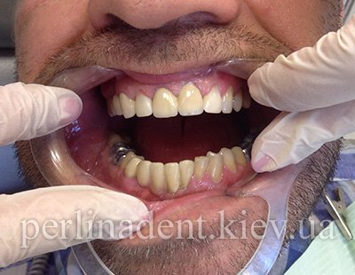 Зубные протезы из металлокерамики стоимость