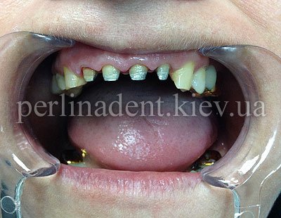 протезирвоание зубов металлокерамика