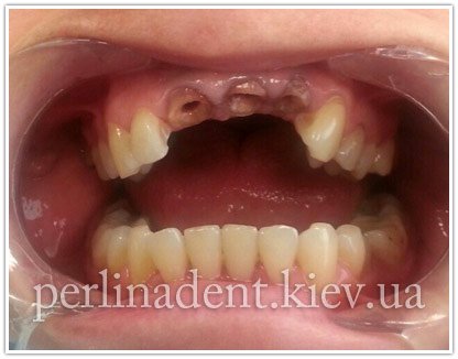 Зубные протезы из металлокерамики в Киеве