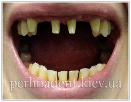 зубное протезирование Киев