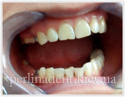 варианты протезирования зубов