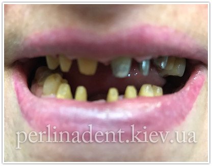 стоимость протезирования зубов в Киеве
