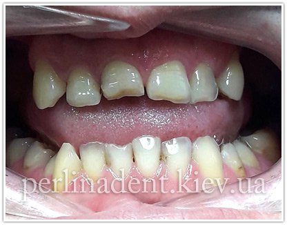 Зубные протезы из металлокерамики, услуги стоматологии