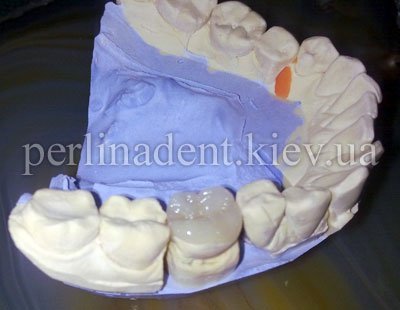 зубное протезирование