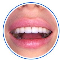 Протезування зубів (види і ціни)