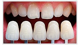 Реставрация зубов керамическими винирами