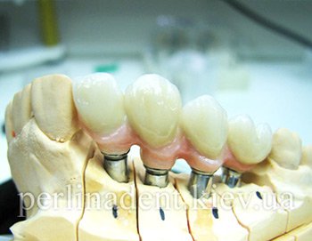 Имплантация зубов Киев цены 