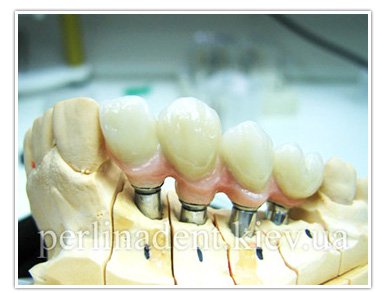 Імплантація зубів Київ ціни