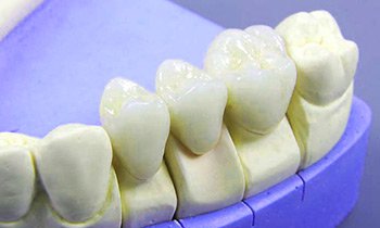 Зубные протезы цена