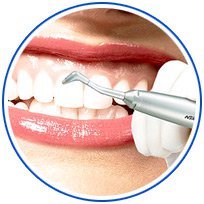 Чистка зубов методом Air flow 