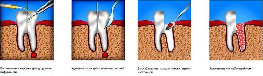 Гемисекция – удаление части зуба с корнем