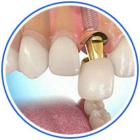 имплантация зубов киев