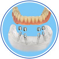 зубы имплантация